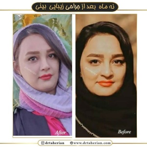 جراحی-بینی-358