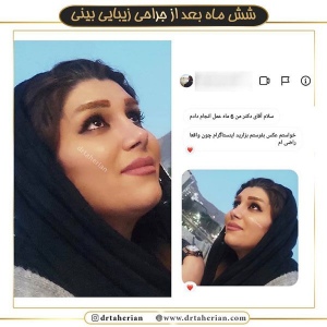 جراحی-بینی-361