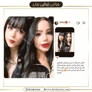 جراحی-بینی-362