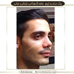 جراحی-بینی-363