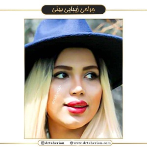 جراحی-بینی-364