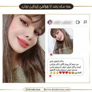 جراحی-بینی-367