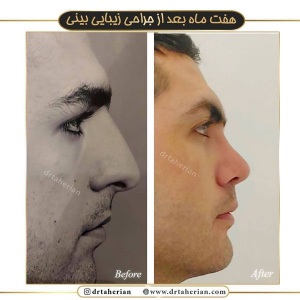 جراحی-بینی-368