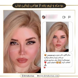 جراحی-بینی-369