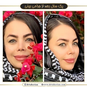 جراحی-بینی-370