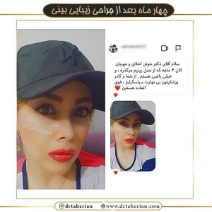 جراحی-بینی-371