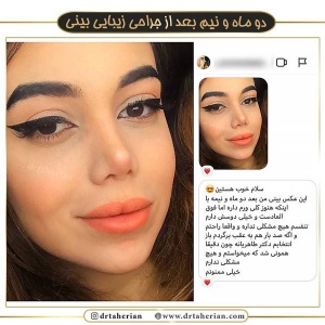 جراحی-بینی-372