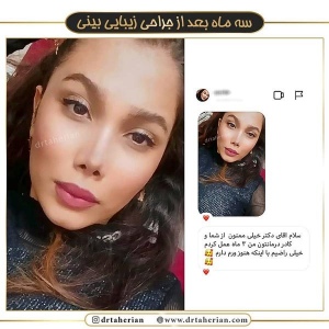 جراحی-بینی-373