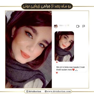 جراحی-بینی-375