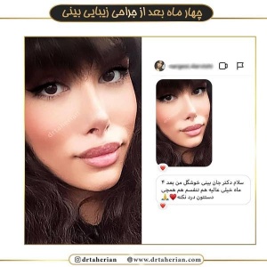 جراحی-بینی-376