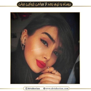 جراحی-بینی-377