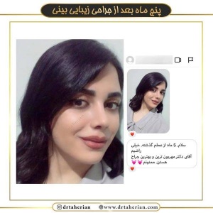 جراحی-بینی-378