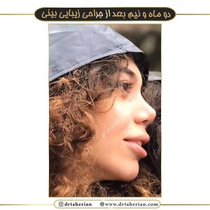 جراحی-بینی-379