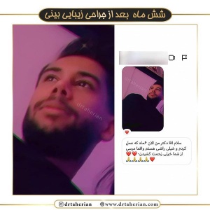 جراحی-بینی-381