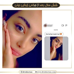 جراحی-بینی-384