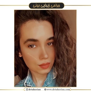 جراحی-بینی-386