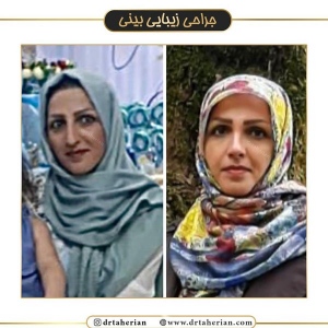 جراحی-بینی-387