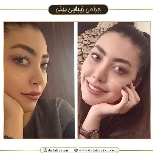 جراحی-بینی-388