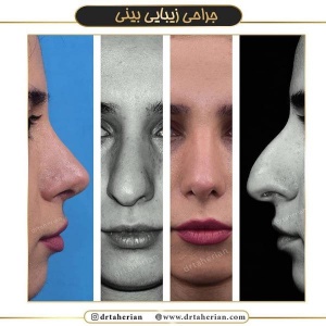 جراحی-بینی-389