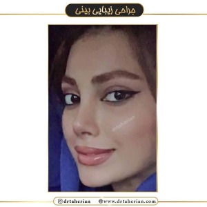 جراحی-بینی-390