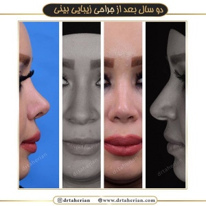 جراحی-بینی-391
