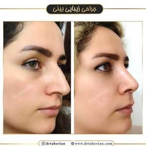 جراحی-بینی-393