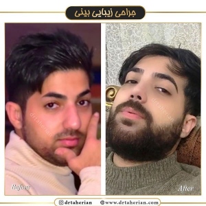 جراحی-بینی-394