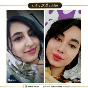 جراحی-بینی-396