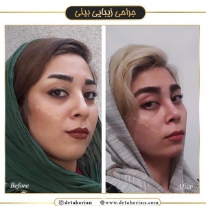 جراحی-بینی-398