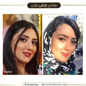 جراحی-بینی-399