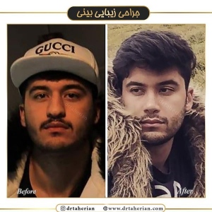 جراحی-بینی-400