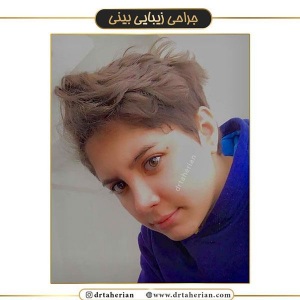 جراحی-بینی-401