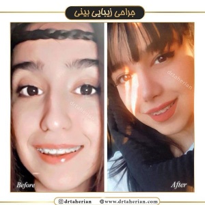 جراحی-بینی-402