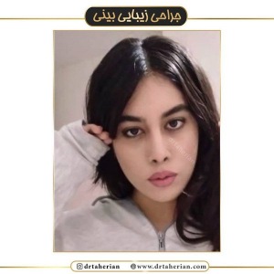 جراحی-بینی-403