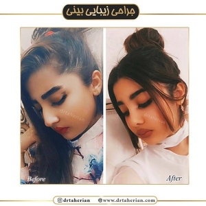 جراحی-بینی-404