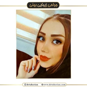 جراحی-بینی-405