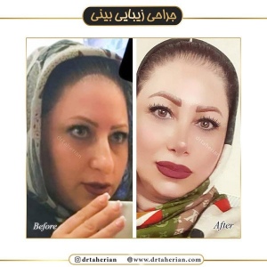 جراحی-بینی-409