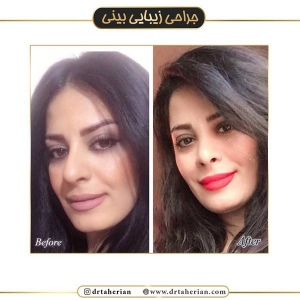 جراحی-بینی-411