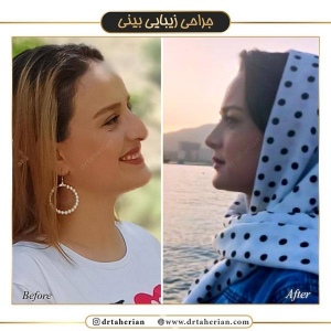 جراحی-بینی-416