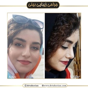 جراحی-بینی-418