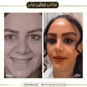 جراحی-بینی-419