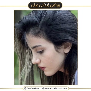 جراحی-بینی-420