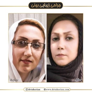 جراحی-بینی-421