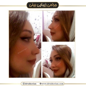 جراحی-بینی-423
