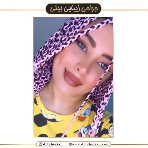 جراحی-بینی-424