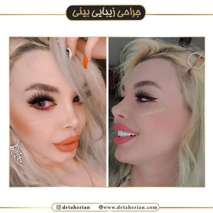 جراحی-بینی-425