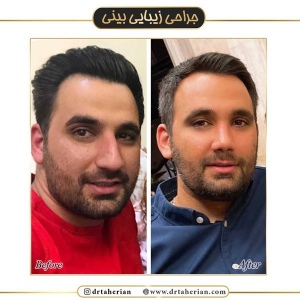 جراحی-بینی-427