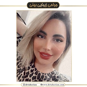 جراحی-بینی-429