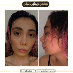 جراحی-بینی-430