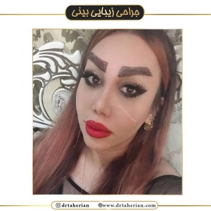 جراحی-بینی-432